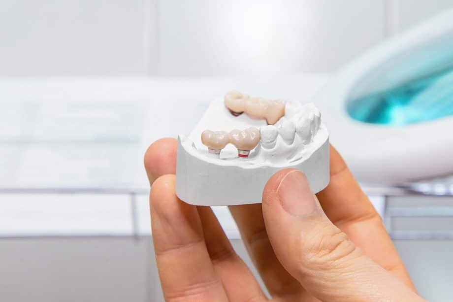 How Should a Dental Bridge Fit