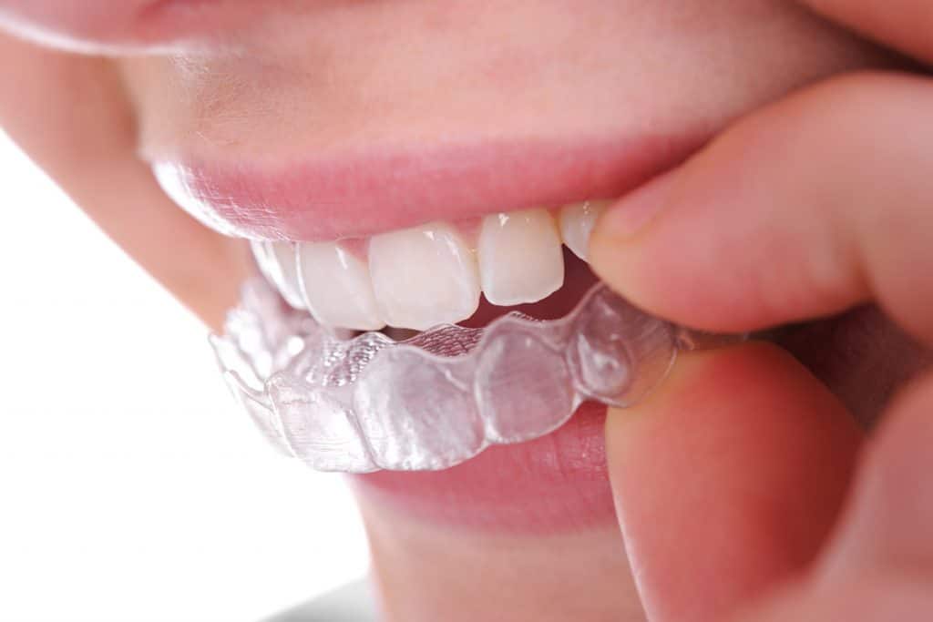 how-long-do-you-have-to-wear-invisalign